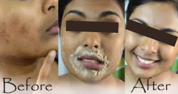 before/after natural acne treatment sequence showing paste application on face for acne control
