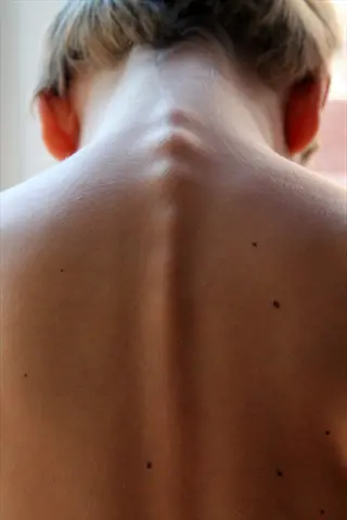 close-up view of human back skin on the upper back, showing the spine, skin texture, and scattered moles