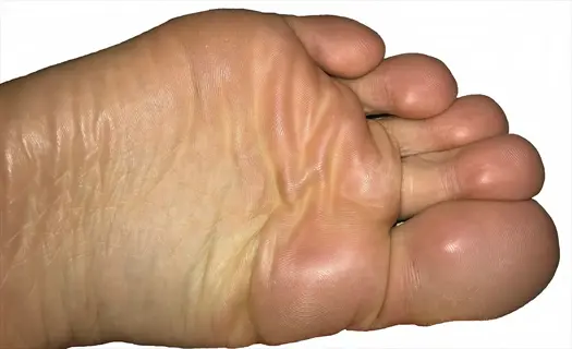 close-up view of the sole of a human foot, showing skin texture and toes