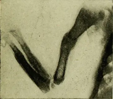 historical medical illustration of a child's bowed legs caused by rickets