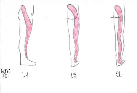 medical illustration of nerve root distributions (l4, l5, s1) in human legs showing pink-shaded regions. demonstrates proximal muscle weakness patterns in legs related to nerve root involvement