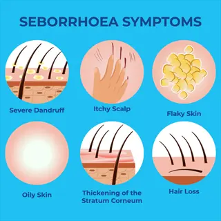 seborrhoea symptoms infographic showing scalp issues including severe dandruff - conditions treated by scalp treatment dandruff solutions
